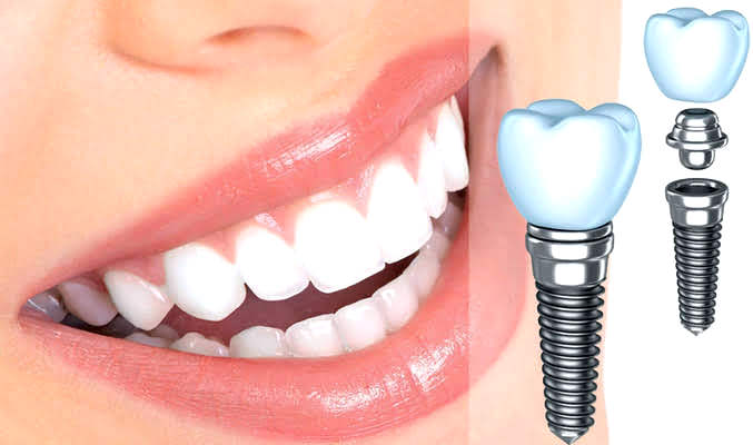 Имплантация зубов  Implant-0021
