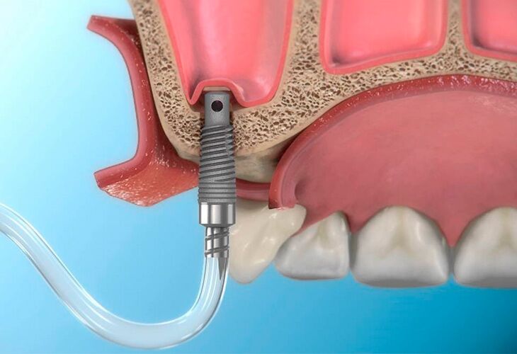 имплантация зуба синус-лифтинг