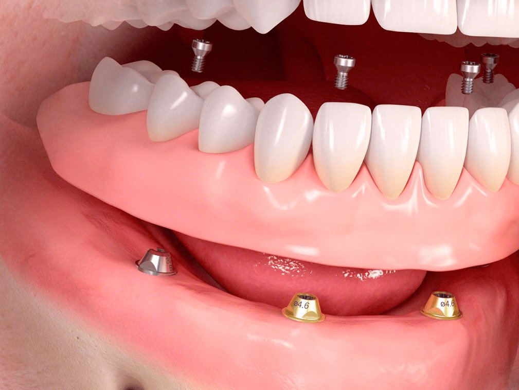 имплантация зубов в москве под ключ недорого