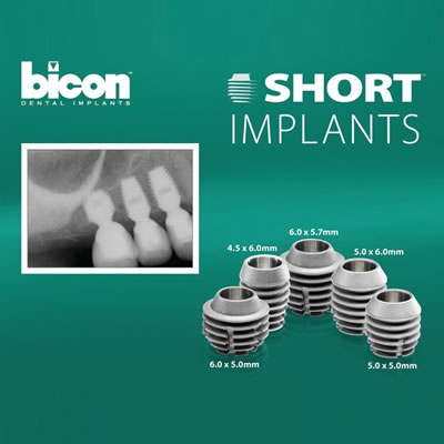 Имплантация Bicon