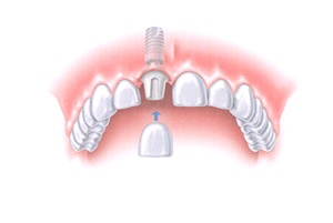 имплантация переднего зуба под ключ