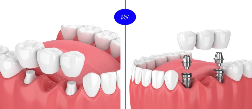 dental-implants-vs-dental-bridge.jpg