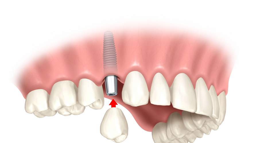 имплантация передних нижних зубов